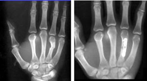 metacarpal2