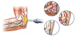 ShockwaveTherapy_02